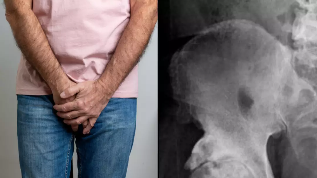 Man goes to doctors for hip X-ray and finds out his penis is turning into bone